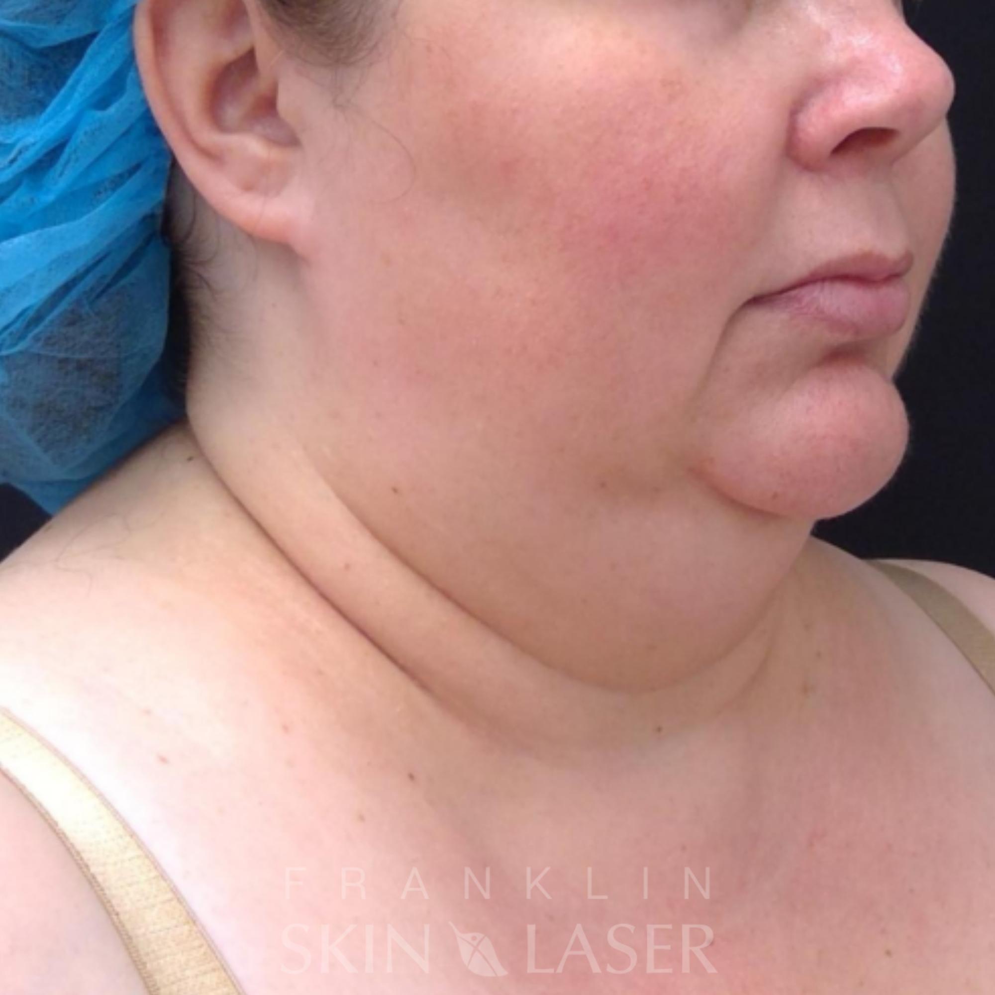 Kybella Nashville Franklin Fat Dissolving Franklin Skin And Laser