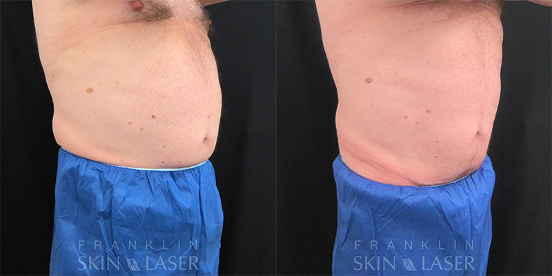 Emsculpt NEO Before & After Image