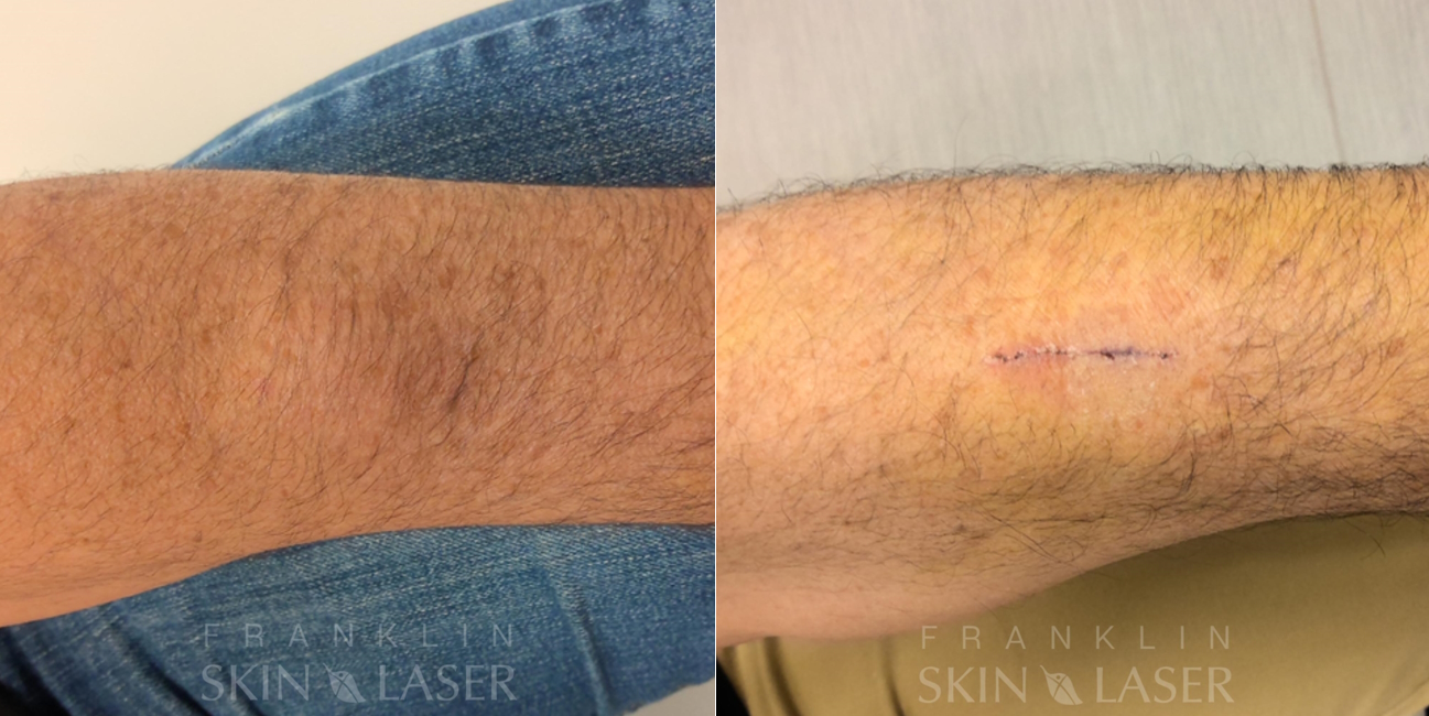 Cyst & Lipoma Removal Before & After Image