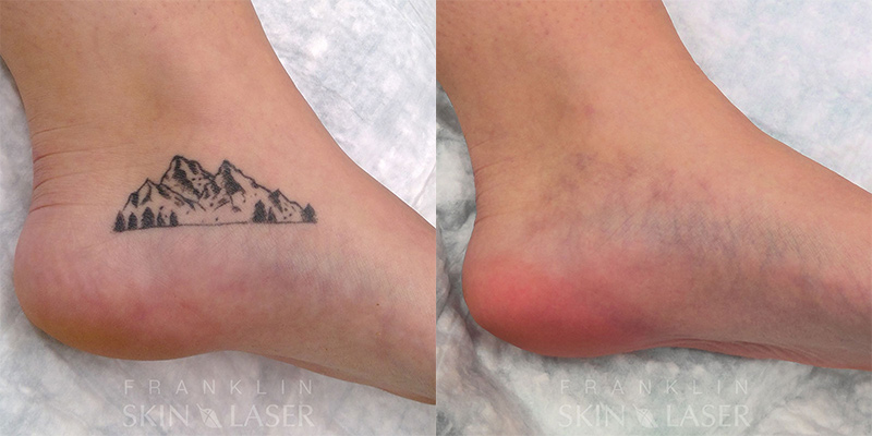 Tattoo Removal Before & After Image
