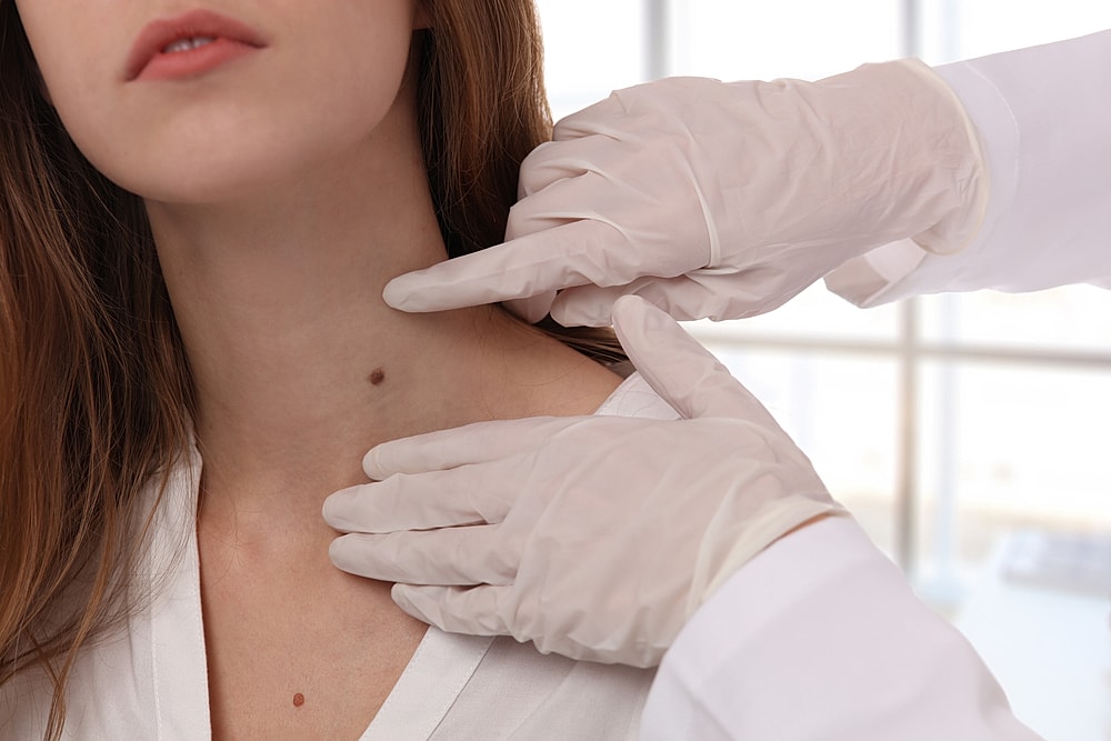 Mole Removal: The Healing Process Explained