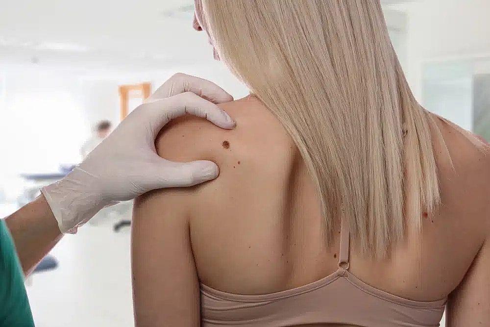 Safe and Effective Laser Mole Removal