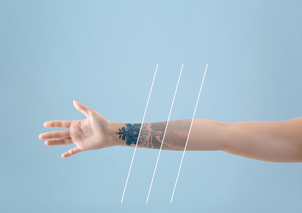 Tattoo Regret? Here’s What You Should Know About Tattoo Removal