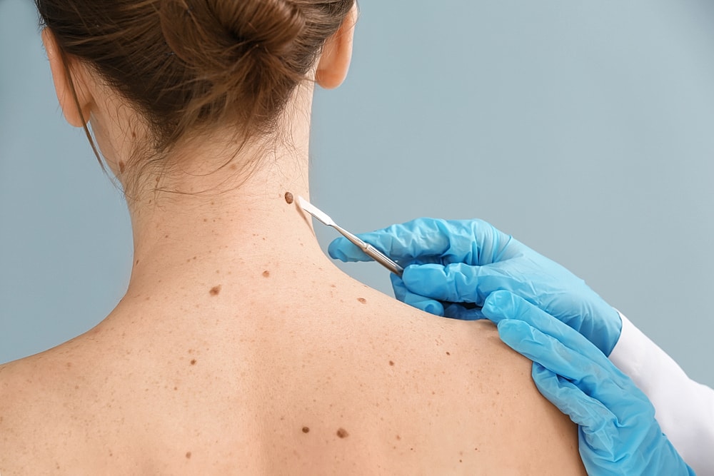 What to Expect After a Mole Removal Procedure