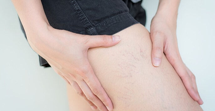 Why is Sclerotherapy the Ultimate Varicose Veins Treatment?