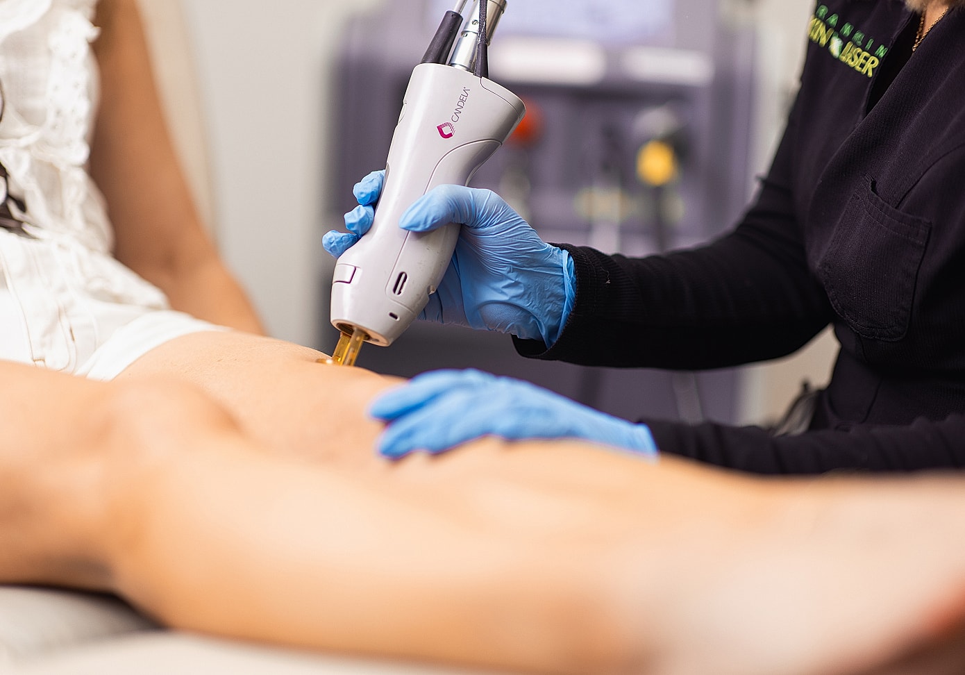 Laser hair removal treatment in progress.