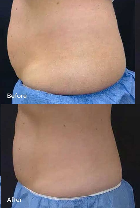 Body contouring before and after results comparison