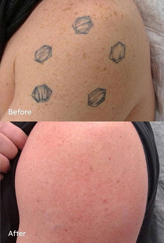 Tattoo removal before and after comparison.
