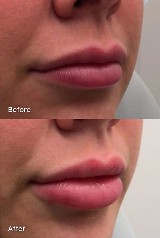 Before and after lip enhancement comparison.