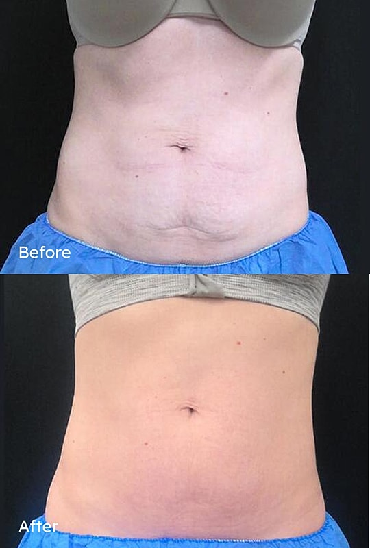 Before and after body transformation comparison.
