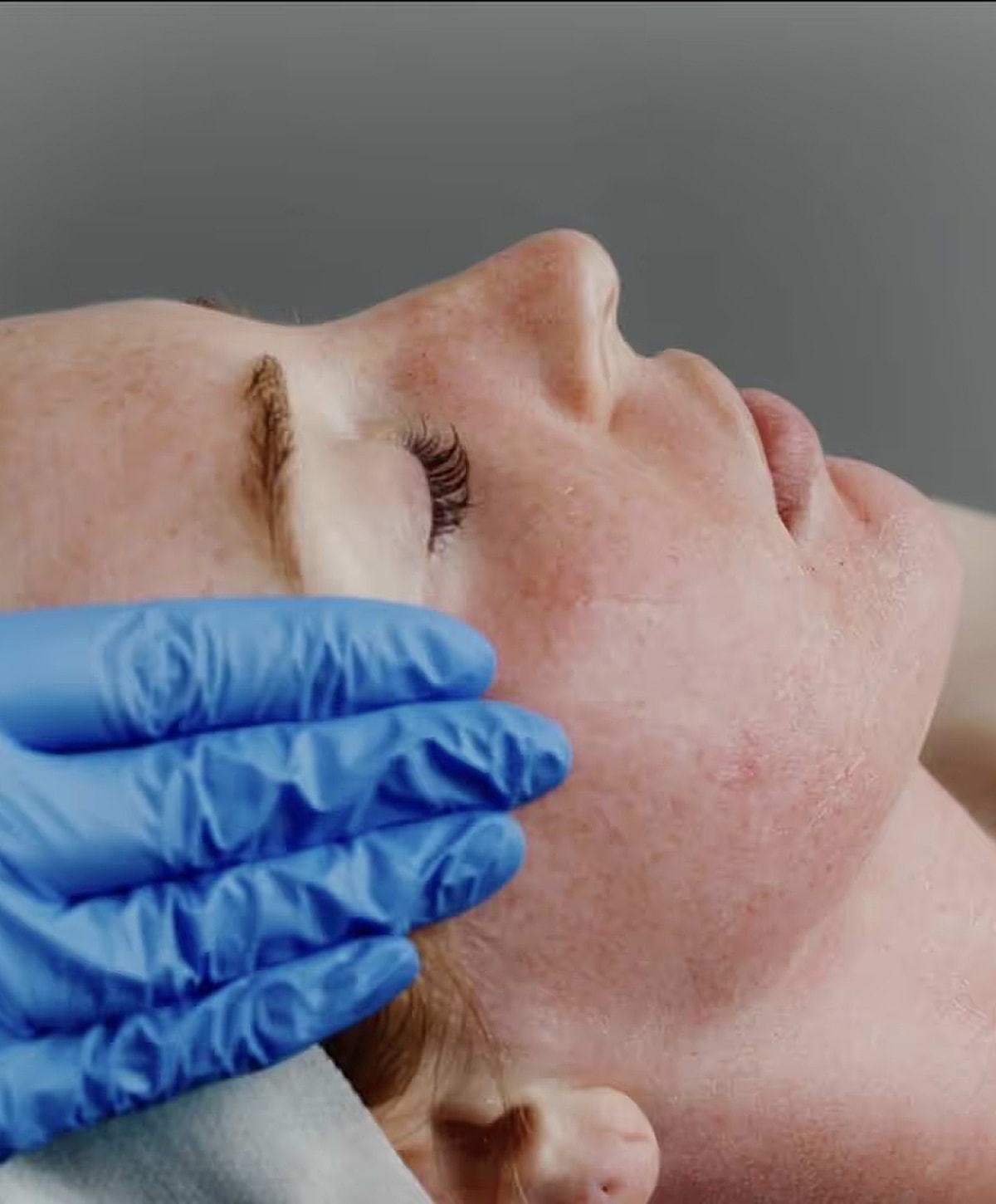 SkinPen Microneedling Franklin, TN