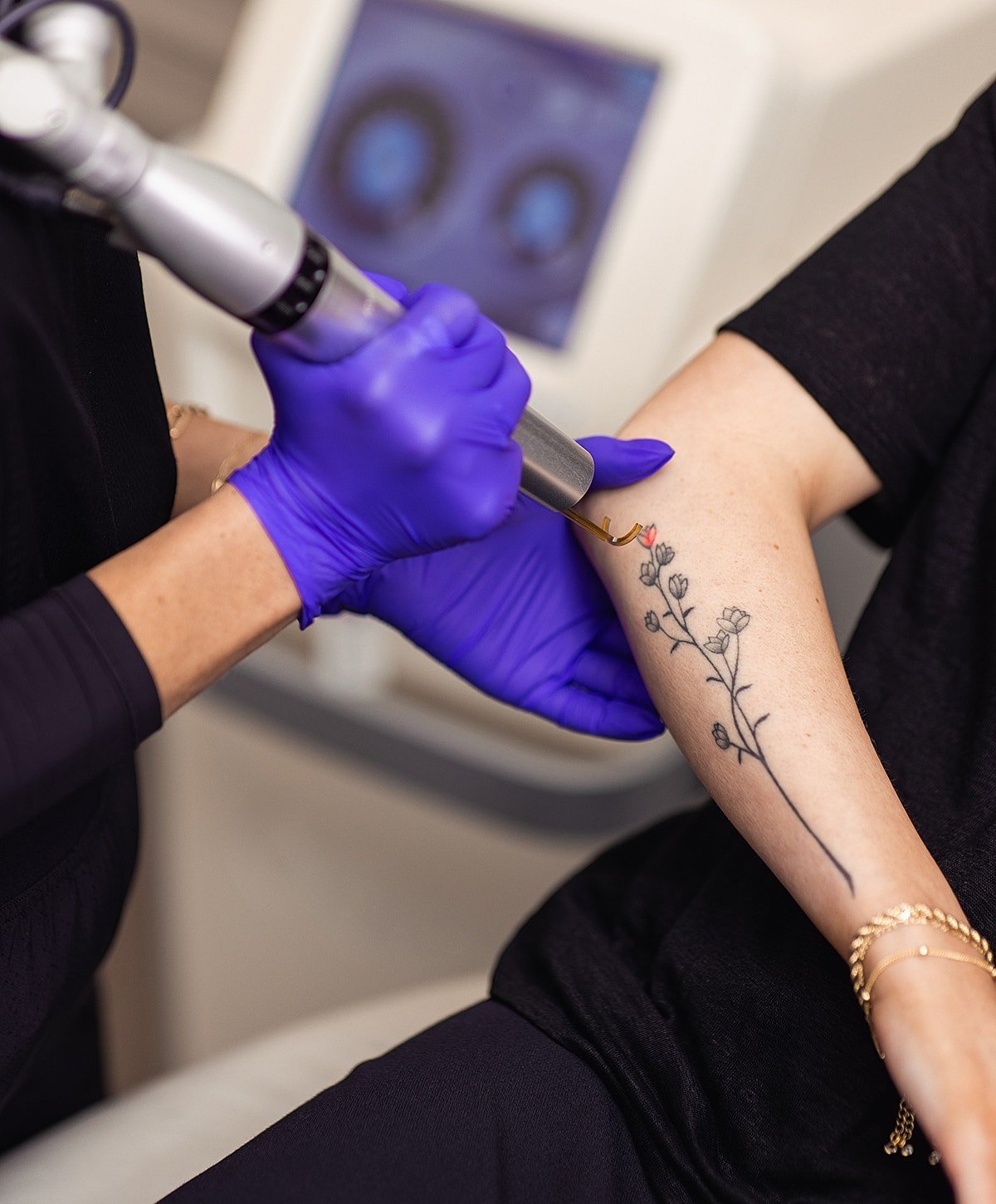 Tattoo removal procedure in progress on arm.