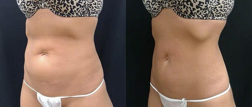 CoolTone Before & After Image