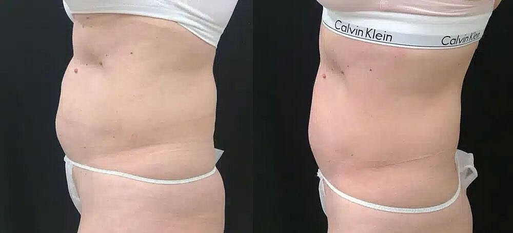 CoolTone Before & After Image