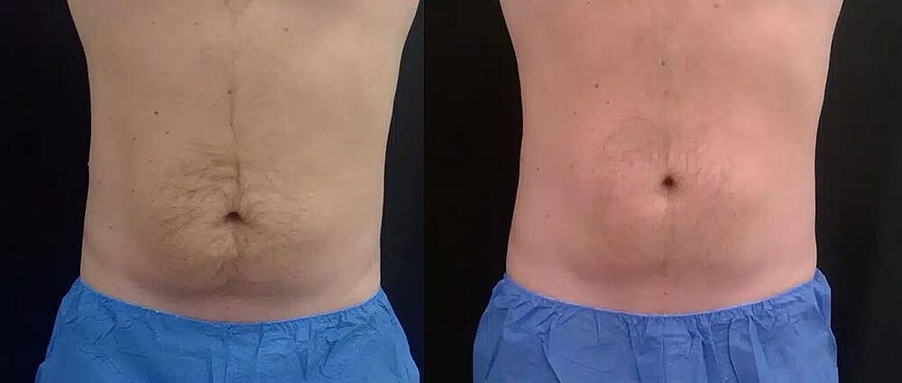 CoolTone Before & After Image