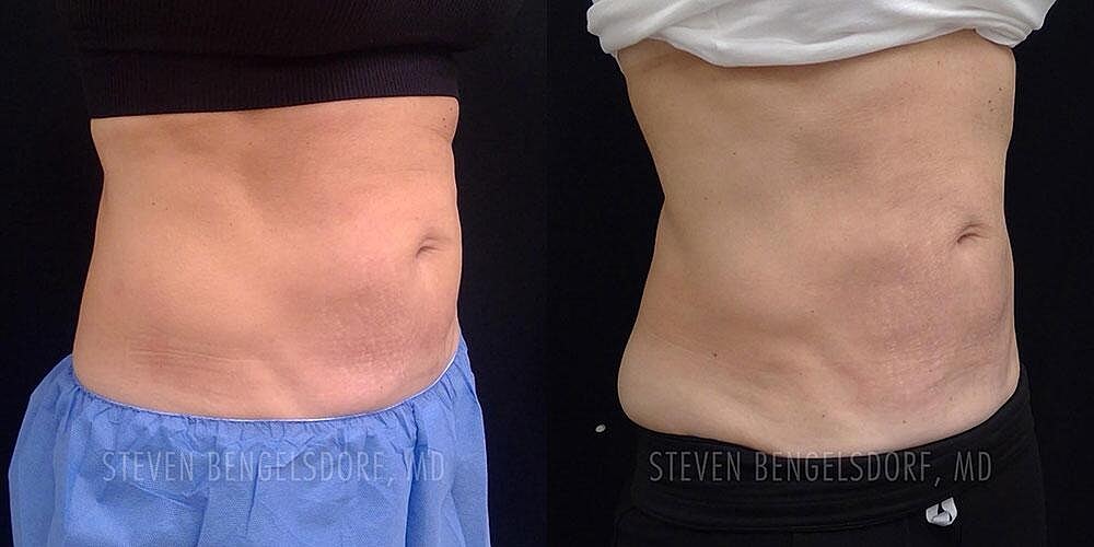 CoolTone Before & After Image
