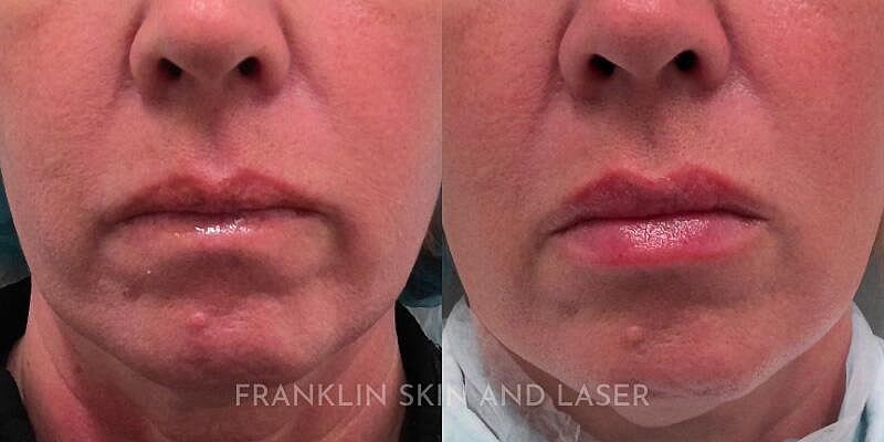 Lip Filler Before & After Image