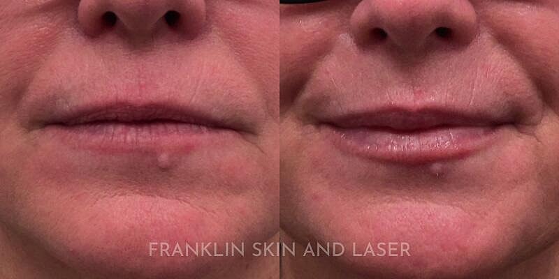 Lip Filler Before & After Image