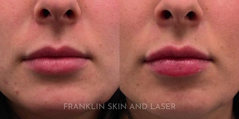 Lip Filler Before & After Image