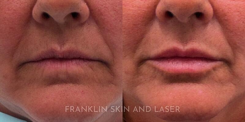 Lip Filler Before & After Image
