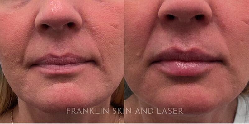 Lip Filler Before & After Image