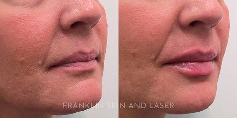 Lip Filler Before & After Image