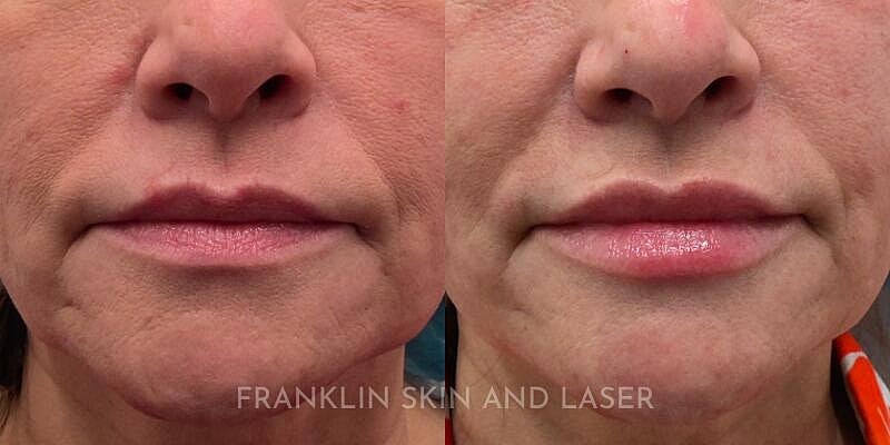 Lip Filler Before & After Image