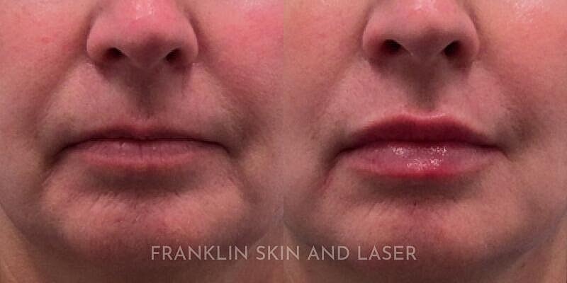 Lip Filler Before & After Image