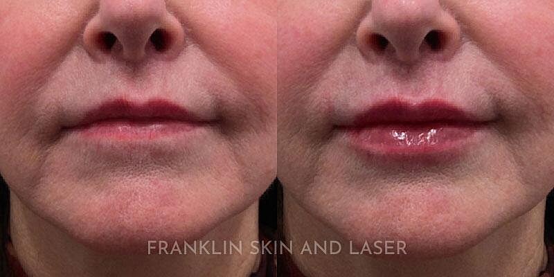 Lip Filler Before & After Image