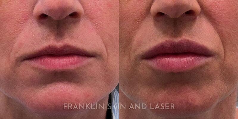 Lip Filler Before & After Image