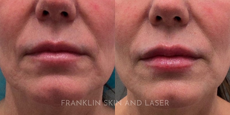 Lip Filler Before & After Image