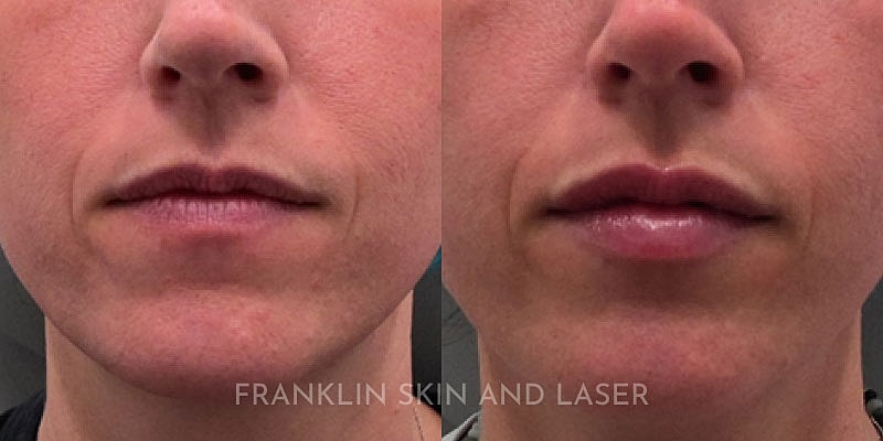 Lip Filler Before & After Image
