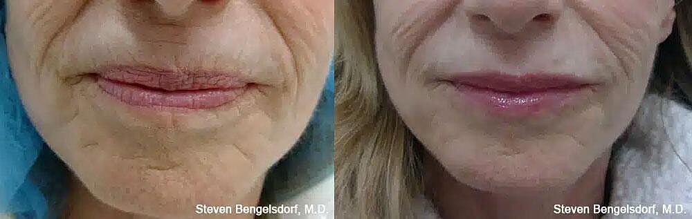 Lip Filler Before & After Image