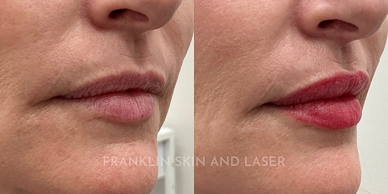 Lip Filler Before & After Image