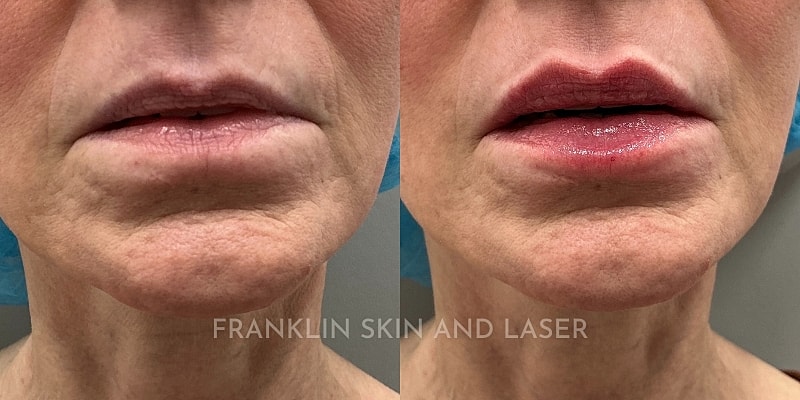 Lip Filler Before & After Image
