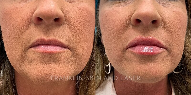 Lip Filler Before & After Image
