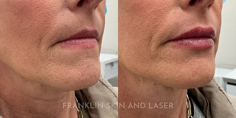 Lip Filler Before & After Image