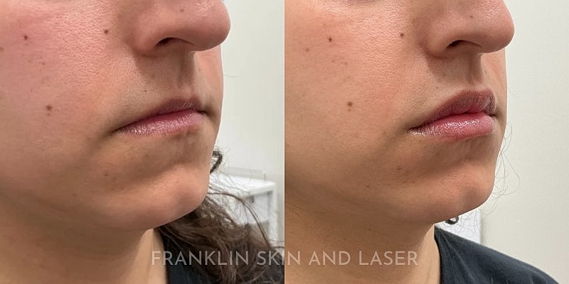 Lip Filler Gallery Before & After
