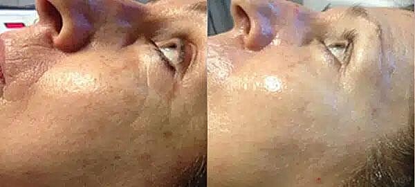 Microneedling Before & After Image
