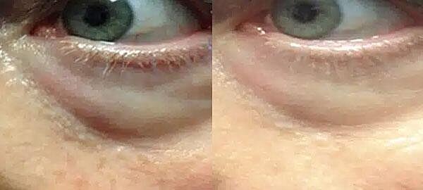 Microneedling Before & After Image