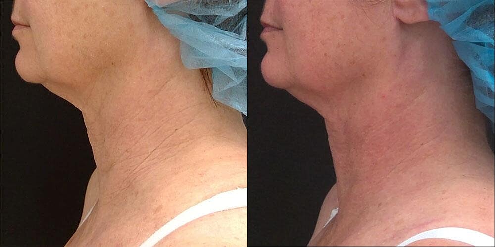 Morpheus8 Face Before & After Image