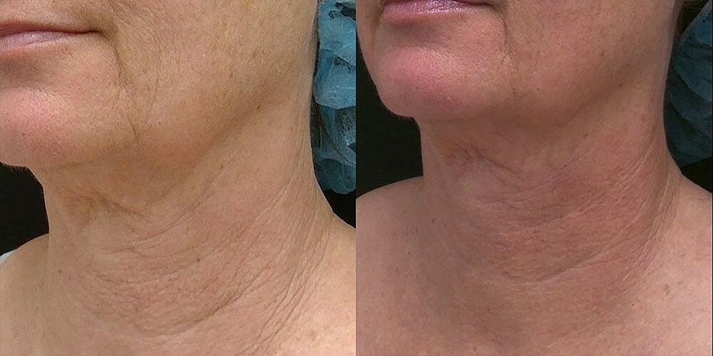 Morpheus8 Face Before & After Image