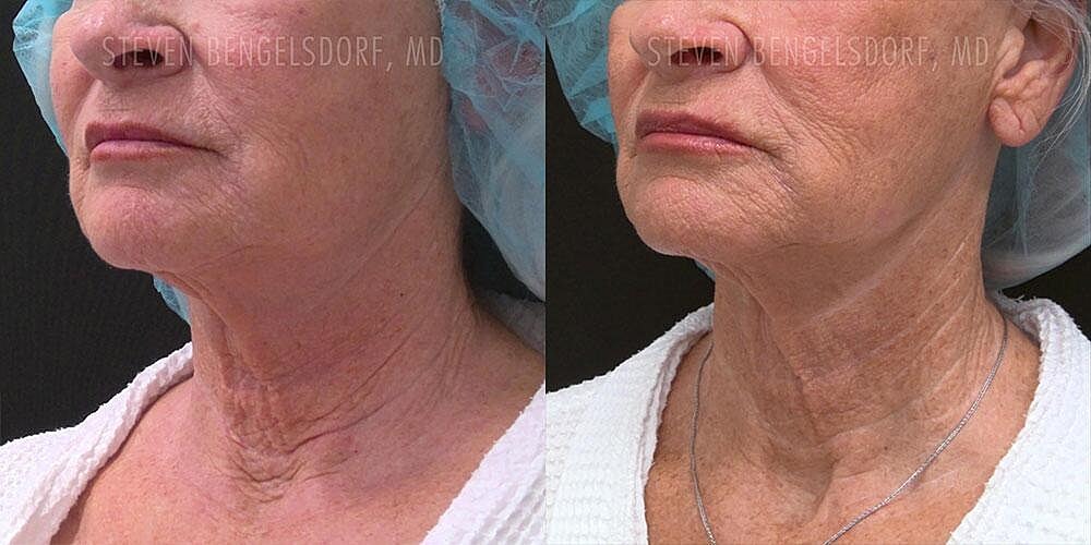 Morpheus8 Face Before & After Image
