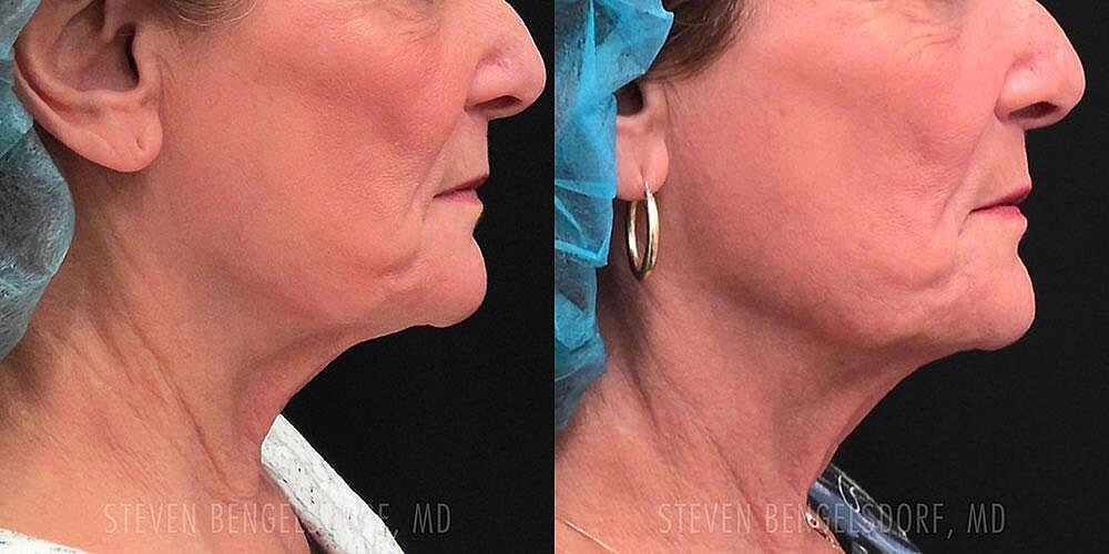 Morpheus8 Face Before & After Image