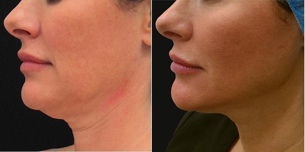 Morpheus8 Face Before & After Image