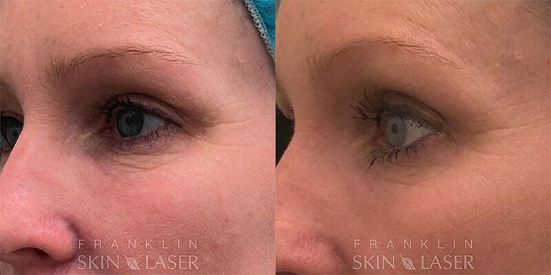 Morpheus8 Face Before & After Image