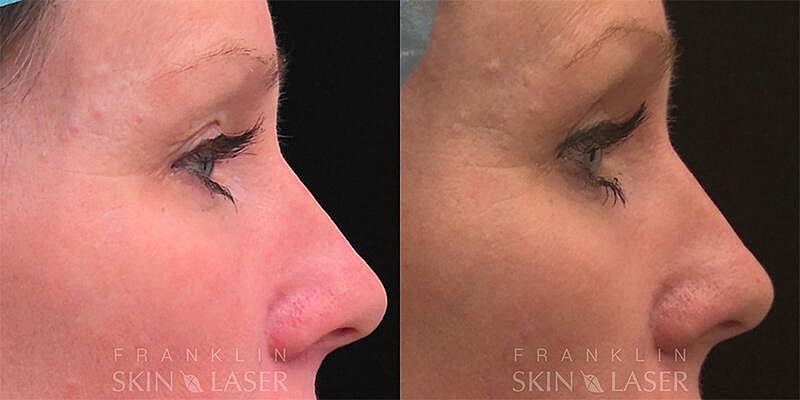 Morpheus8 Face Before & After Image