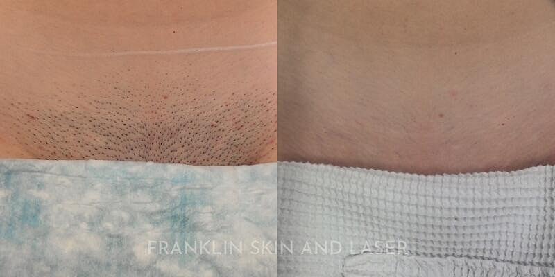 Laser Hair Removal Before & After Image