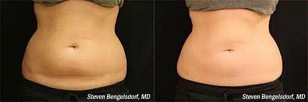 CoolSculpting Before & After Image