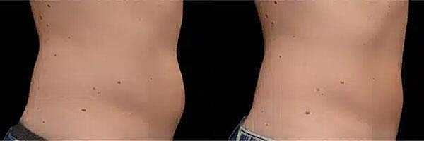 CoolSculpting Before & After Image